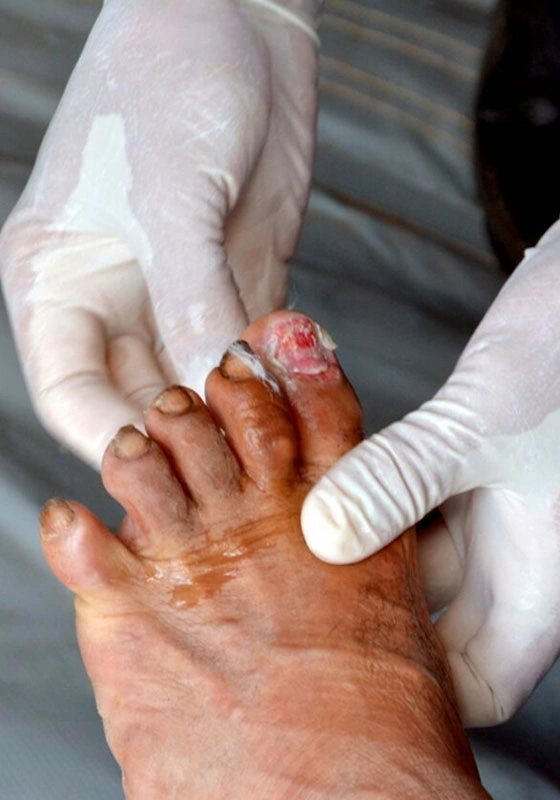 Grupo Médico Quirúrgico CANADI Especialistas en pie diabético heridas crónicas y várices