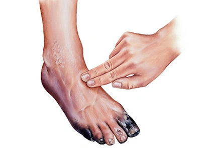 Grupo Médico Quirúrgico CANADI Especialistas en pie diabético heridas crónicas y várices