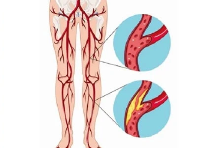 Grupo Médico Quirúrgico CANADI Especialistas en pie diabético heridas crónicas y várices