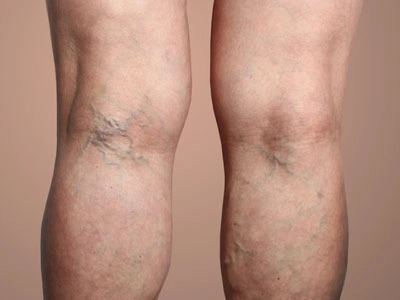 Grupo Médico Quirúrgico CANADI Especialistas en pie diabético heridas crónicas y várices