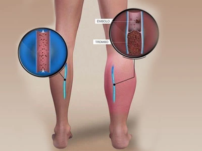 Grupo Médico Quirúrgico CANADI Especialistas en pie diabético heridas crónicas y várices