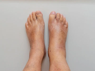 Grupo Médico Quirúrgico CANADI Especialistas en pie diabético heridas crónicas y várices