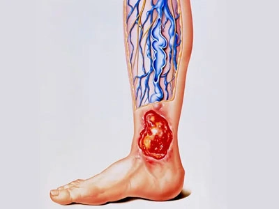 Grupo Médico Quirúrgico CANADI Especialistas en pie diabético heridas crónicas y várices