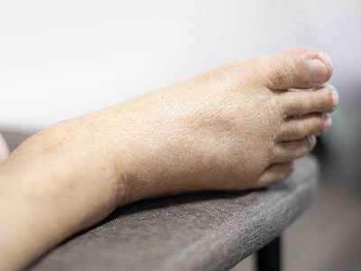 Grupo Médico Quirúrgico CANADI Especialistas en pie diabético heridas crónicas y várices