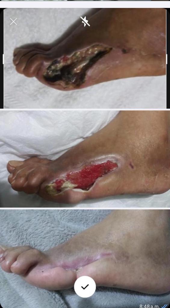 Grupo Médico Quirúrgico CANADI Especialistas en pie diabético heridas crónicas y várices