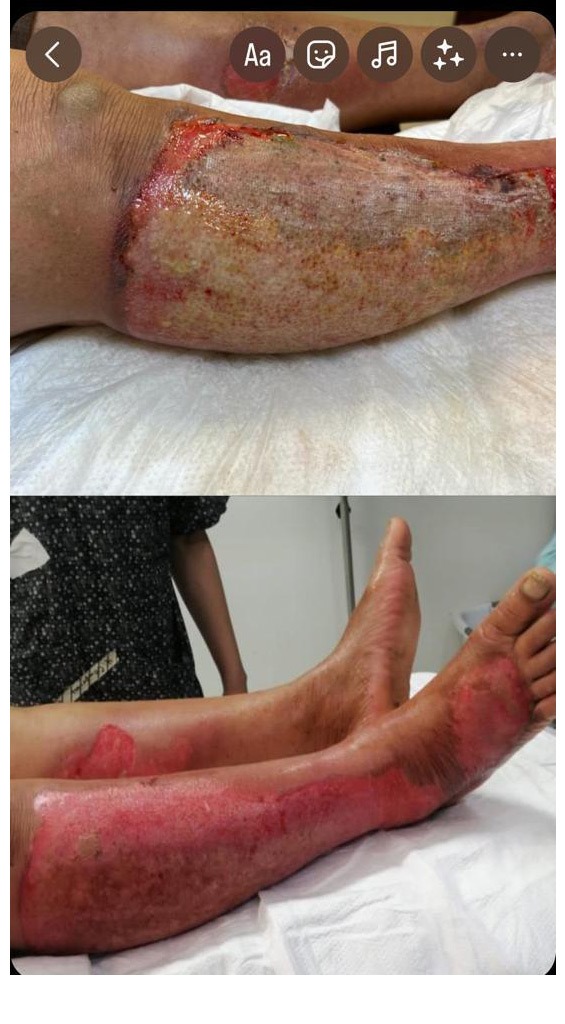 Grupo Médico Quirúrgico CANADI Especialistas en pie diabético heridas crónicas y várices