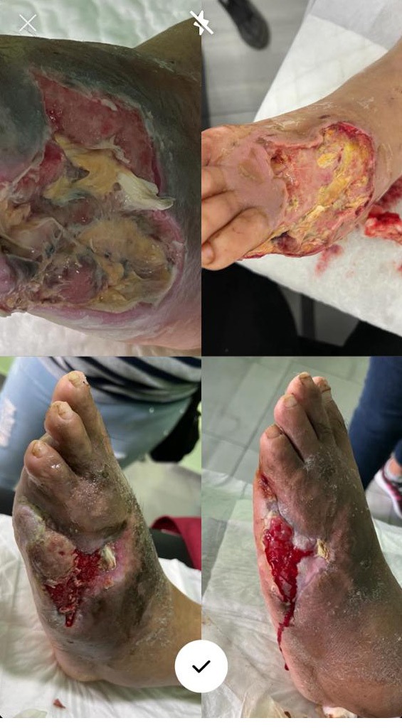 Grupo Médico Quirúrgico CANADI Especialistas en pie diabético heridas crónicas y várices