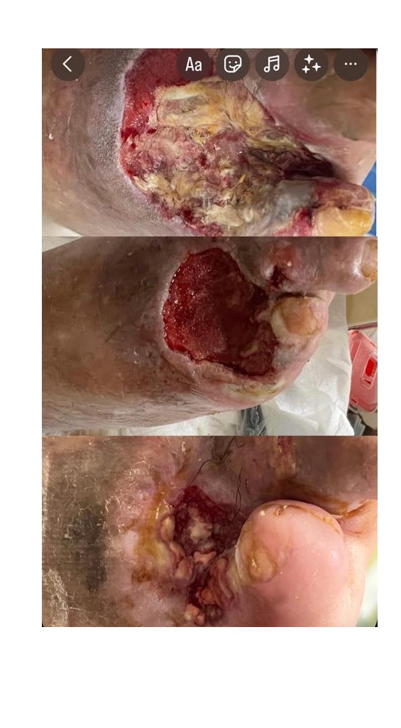 Grupo Médico Quirúrgico CANADI Especialistas en pie diabético heridas crónicas y várices