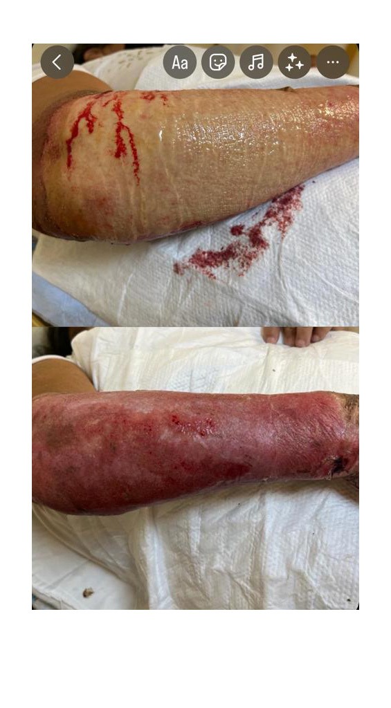 Grupo Médico Quirúrgico CANADI Especialistas en pie diabético heridas crónicas y várices