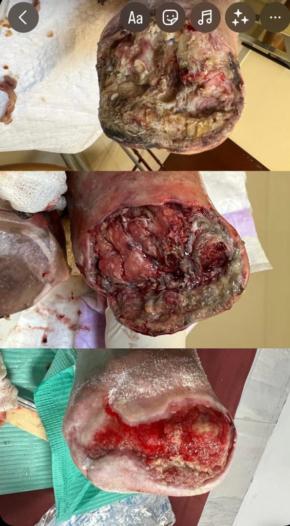 Grupo Médico Quirúrgico CANADI Especialistas en pie diabético heridas crónicas y várices