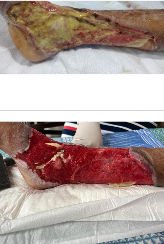 Grupo Médico Quirúrgico CANADI Especialistas en pie diabético heridas crónicas y várices