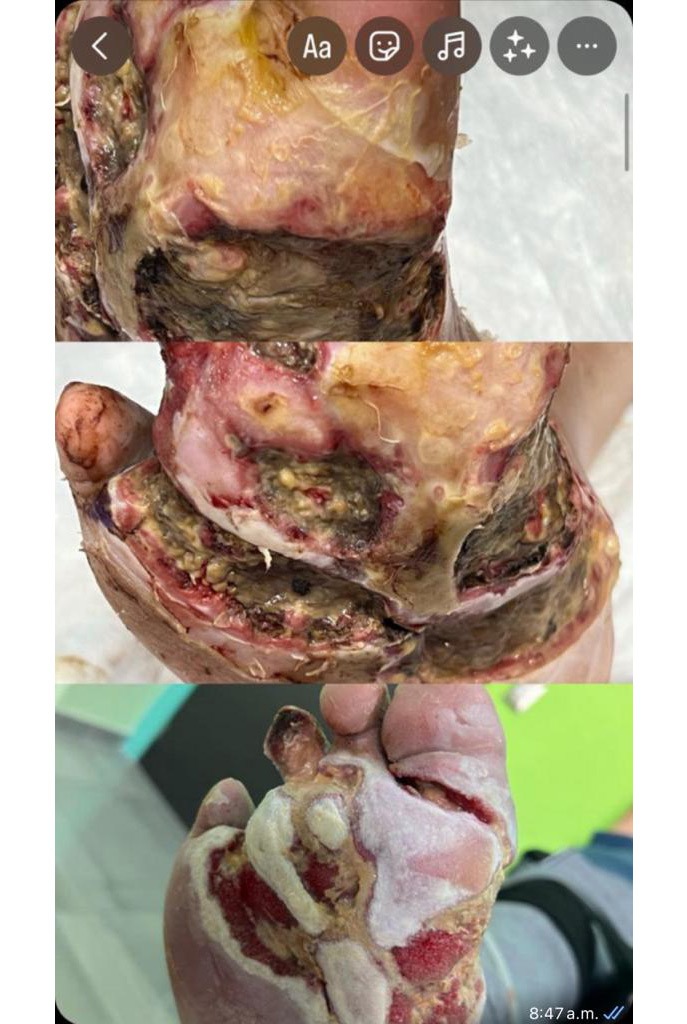 Grupo Médico Quirúrgico CANADI Especialistas en pie diabético heridas crónicas y várices