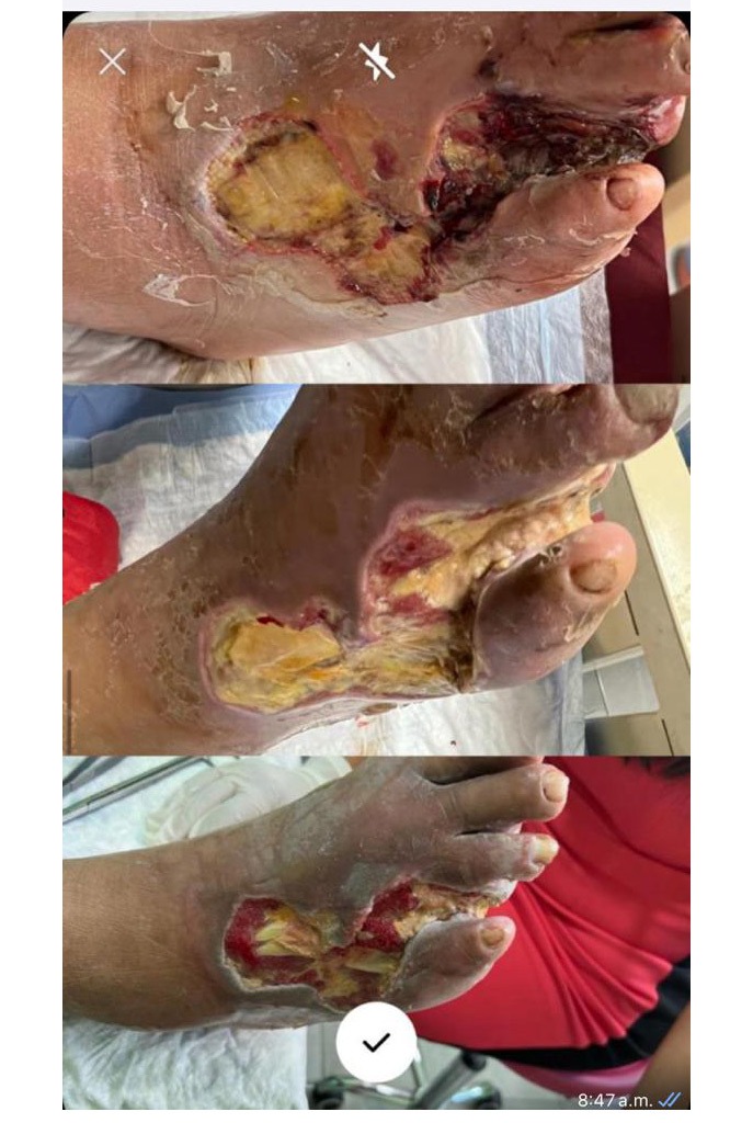 Grupo Médico Quirúrgico CANADI Especialistas en pie diabético heridas crónicas y várices