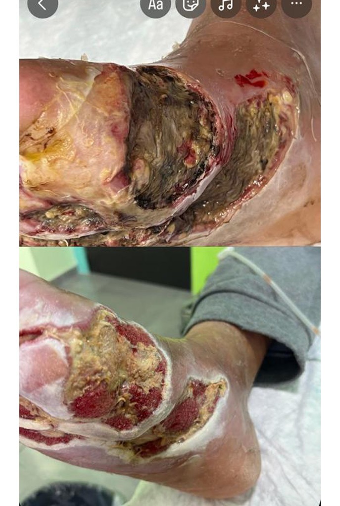 Grupo Médico Quirúrgico CANADI Especialistas en pie diabético heridas crónicas y várices